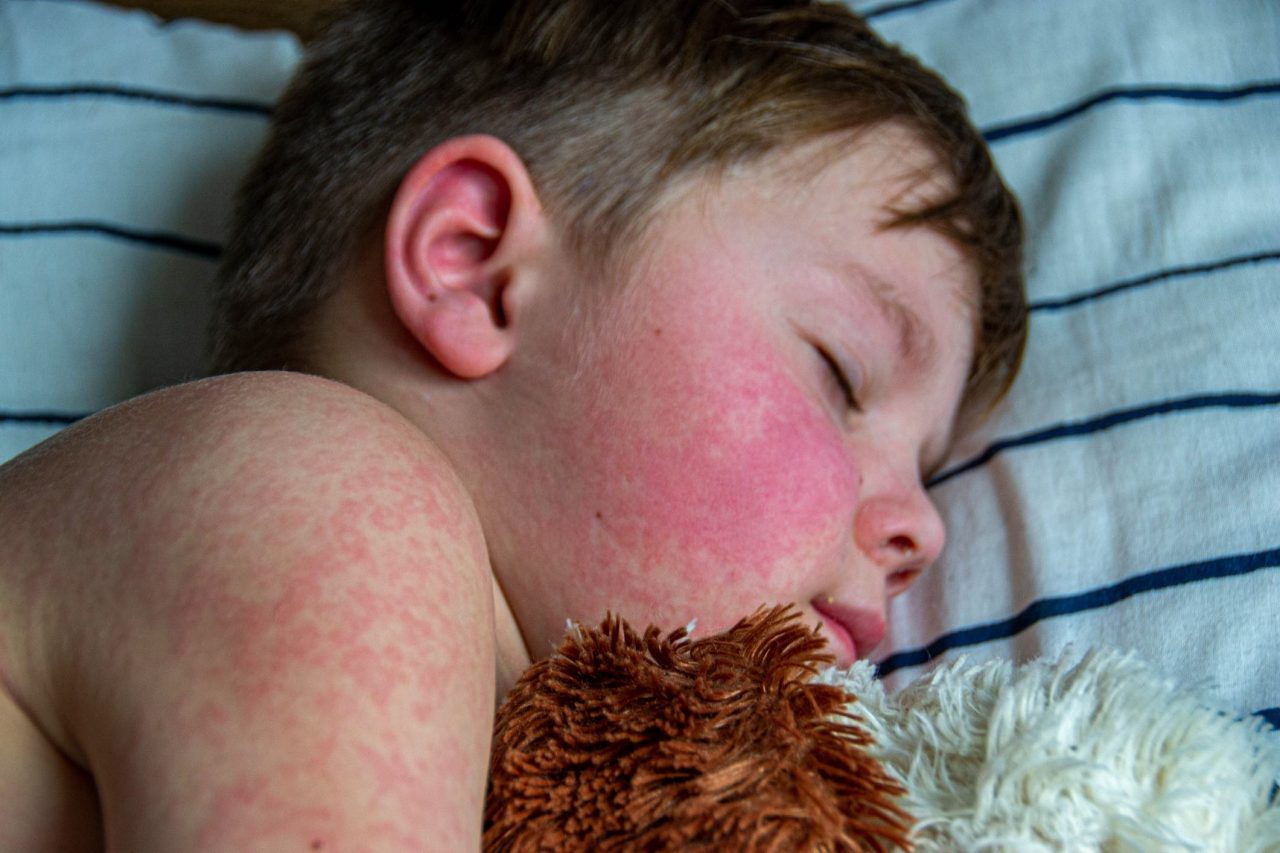 Viral disease. Measles rash on the body of the child. Allergy.